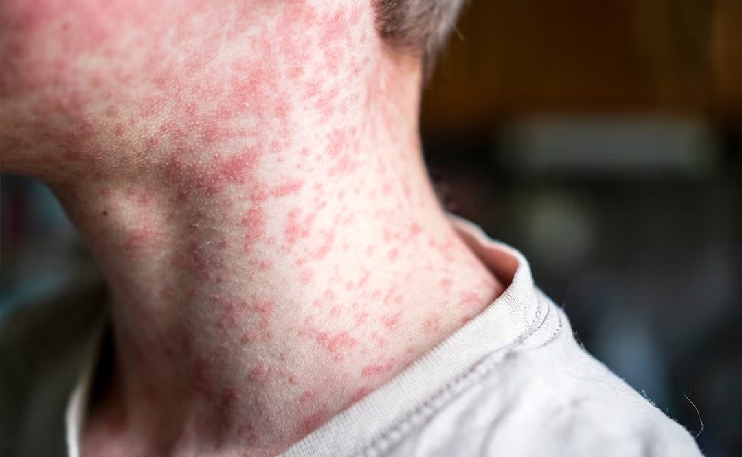 Descartan alerta por sarampión en Tabasco