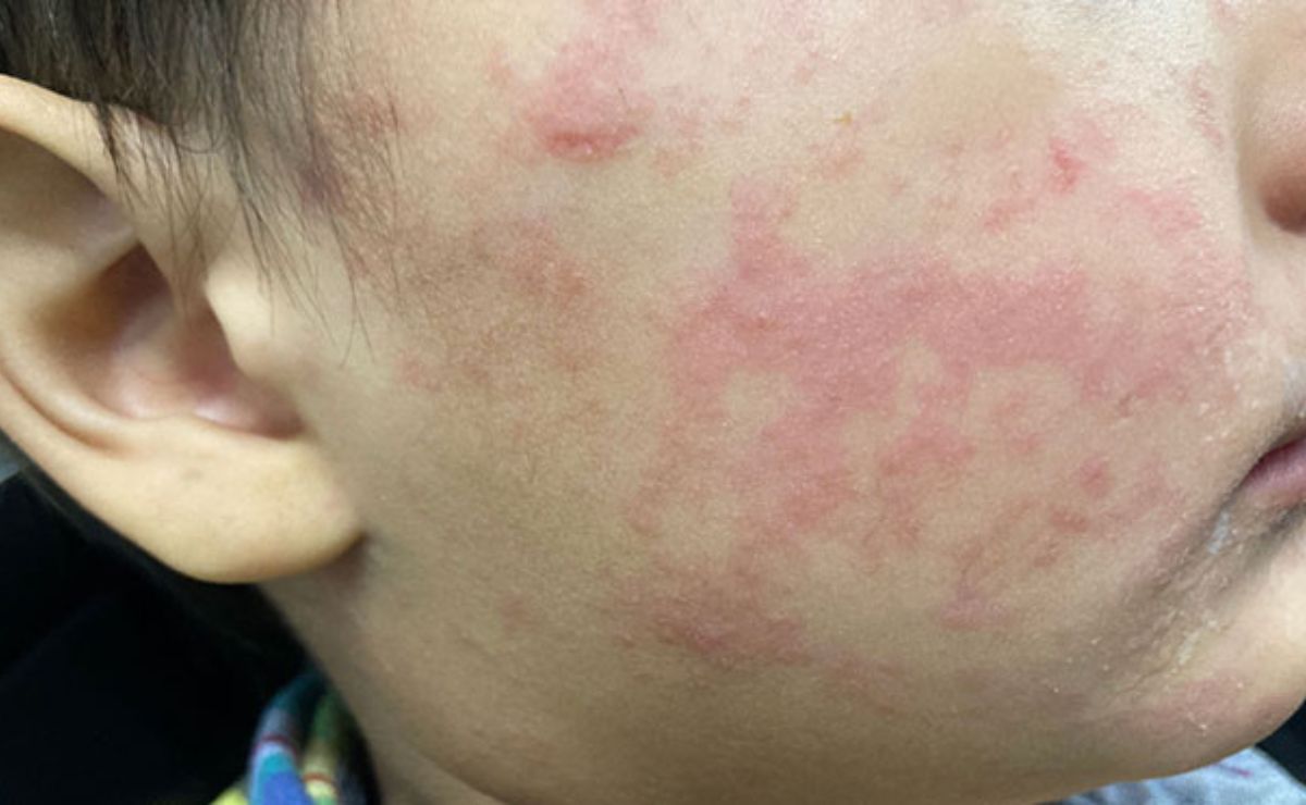 Suman 32 muertes por sarampión; ¿qué estados reportan más casos?