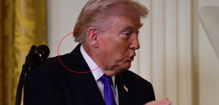 ¿Qué es el sarpullido y la mancha roja en el cuello de Trump?