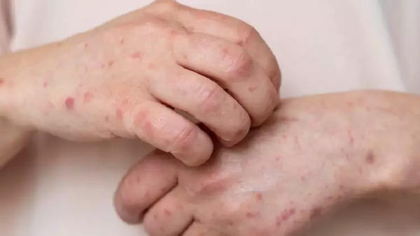 Yucatán registra 23 casos confirmados de sarampión