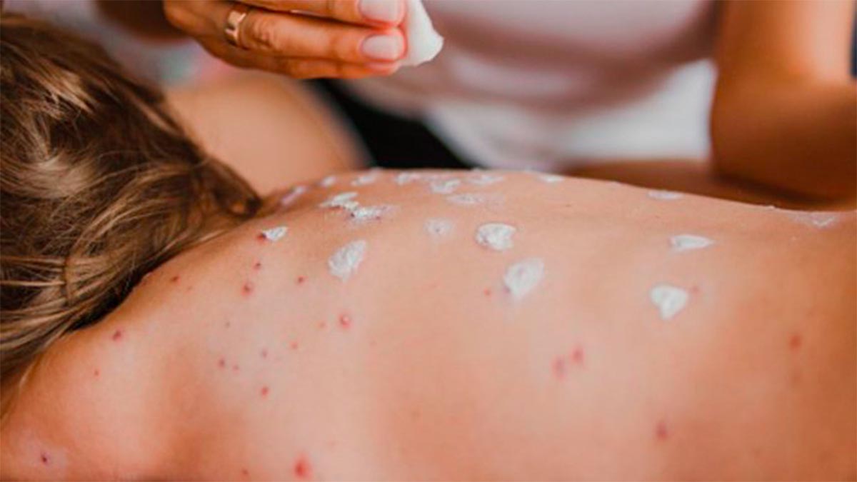 México, epicentro del brote de sarampión en América